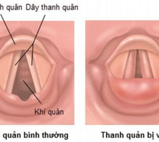 Bơm thuốc thanh quản điều trị khàn tiếng cấp và mạn tính